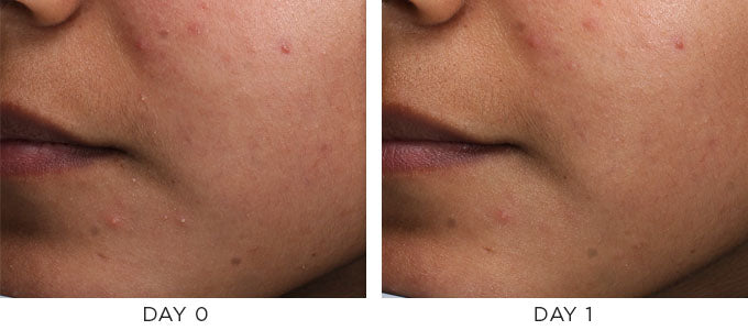 Before and after image showing improvement in acne