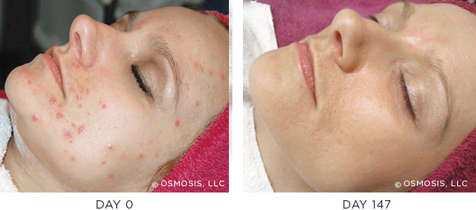 Before and After results showing improvement of blemish-prone and oily skin