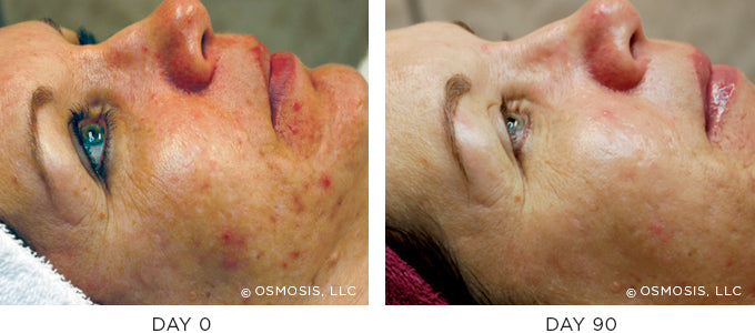 Before and After results showing improvement of blemish-prone and oily skin