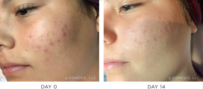 Before and After Acne Recovery