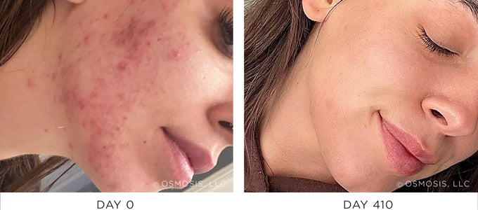 Before and After Acne Results