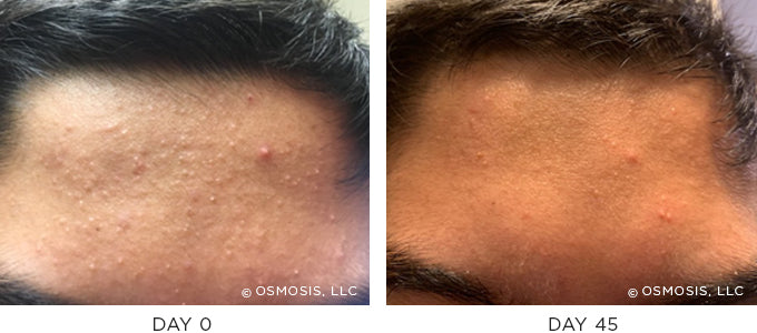 Before and After results showing improvement of blemish-prone and oily skin