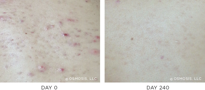 Before and After results showing improvement of blemish-prone and oily skin