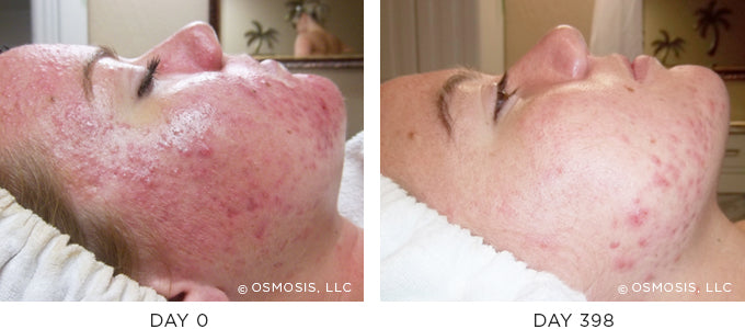 Before and After results showing improvement of blemish-prone and oily skin