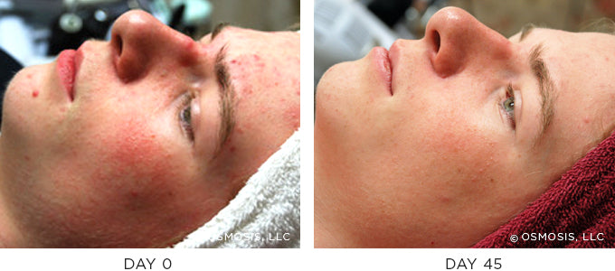 Before and After results showing improvement of blemish-prone and oily skin