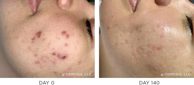 Before and After Photo - Adult Cystic Acne