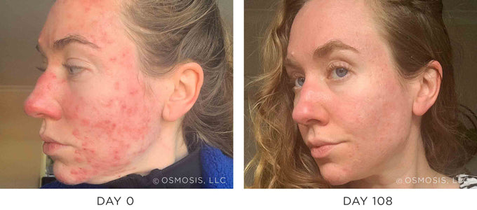 Before and After Results Showing Improvement in Rosacea and Acne