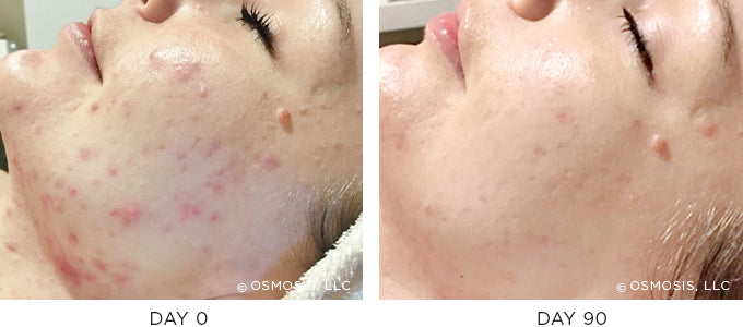 Before and After results showing improvement of blemish-prone and oily skin