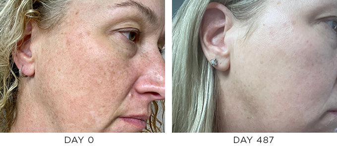 Before and After Showing Improvement in Melasma