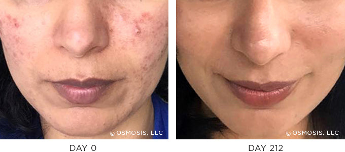 Before and After results showing improvement of blemish-prone and oily skin