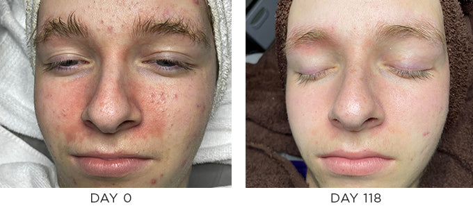 Before and After Photo Showing Improvement in Blemish-Prone Skin