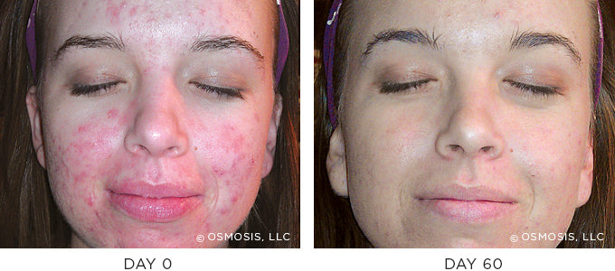 Before and After results showing improvement of blemish-prone and oily skin