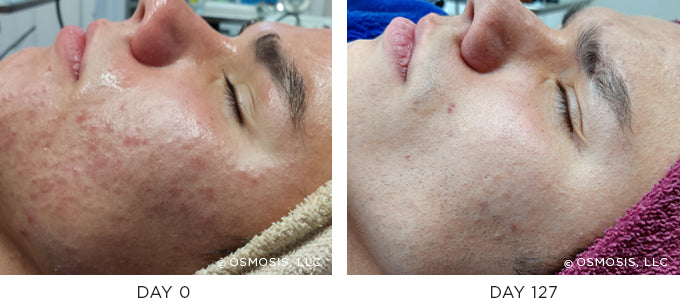 Before and After results showing improvement of blemish-prone and oily skin