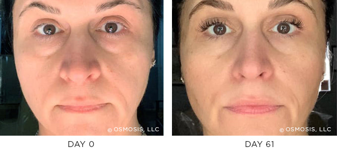 Before and After Client with improvement in eyes, nasal labial fold