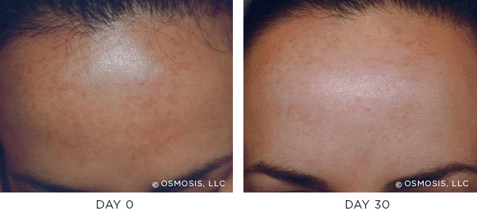 Before and After photo showing improvement in pigmentation and uneven skin tone