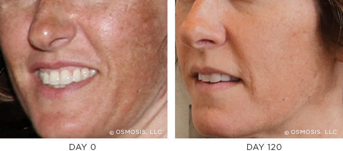 Before and After photo showing improvement in pigmentation and uneven skin tone