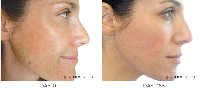 Before and After photo showing improvement in pigmentation and uneven skin tone