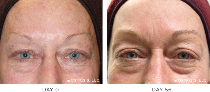 Before and After photo showing improvement in pigmentation and uneven skin tone