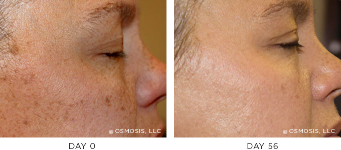 Before and After photo showing improvement in pigmentation and uneven skin tone