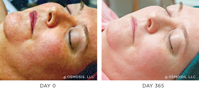 Before and After photo showing improvement in redness and irritation