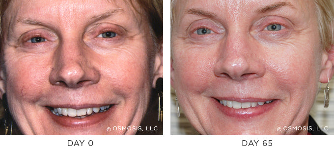 Before and After photo showing improvement in redness and irritation