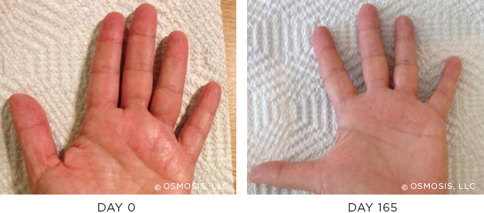 Eczema Psoriasis Before and After – Osmosis Beauty