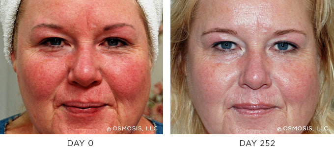 Before and After photo showing improvement in redness and irritation