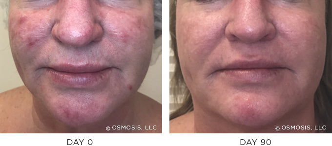 Before and After photo showing improvement in redness and irritation