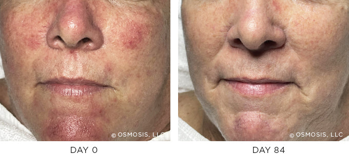 Before and After Photos - Aging skin, sensitive skin, dilated capillaries  