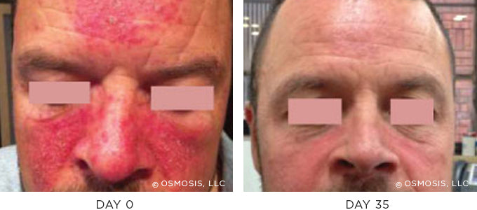 Before and After photo showing improvement in redness and irritation