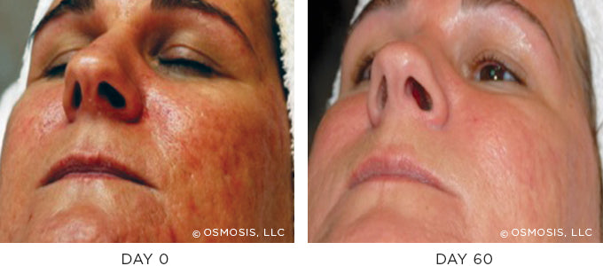 Before and After photo showing improvement in redness and irritation